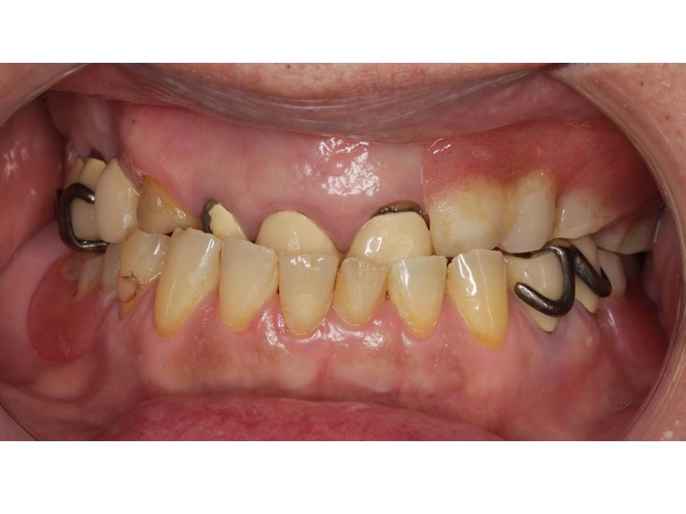 流山でバネを使用しないテレスコープ義歯の治療をしております。