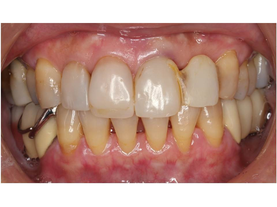 流山の歯科医院でセラミックスを用いた専門治療をしております。