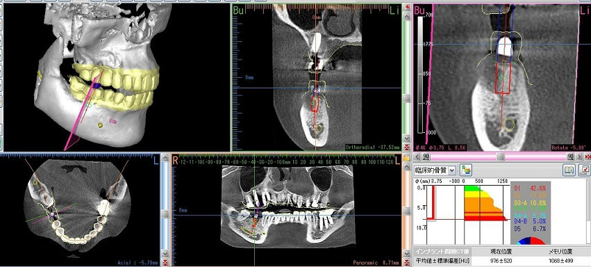 流山の歯科医院でインプラント治療の相談も承っております。