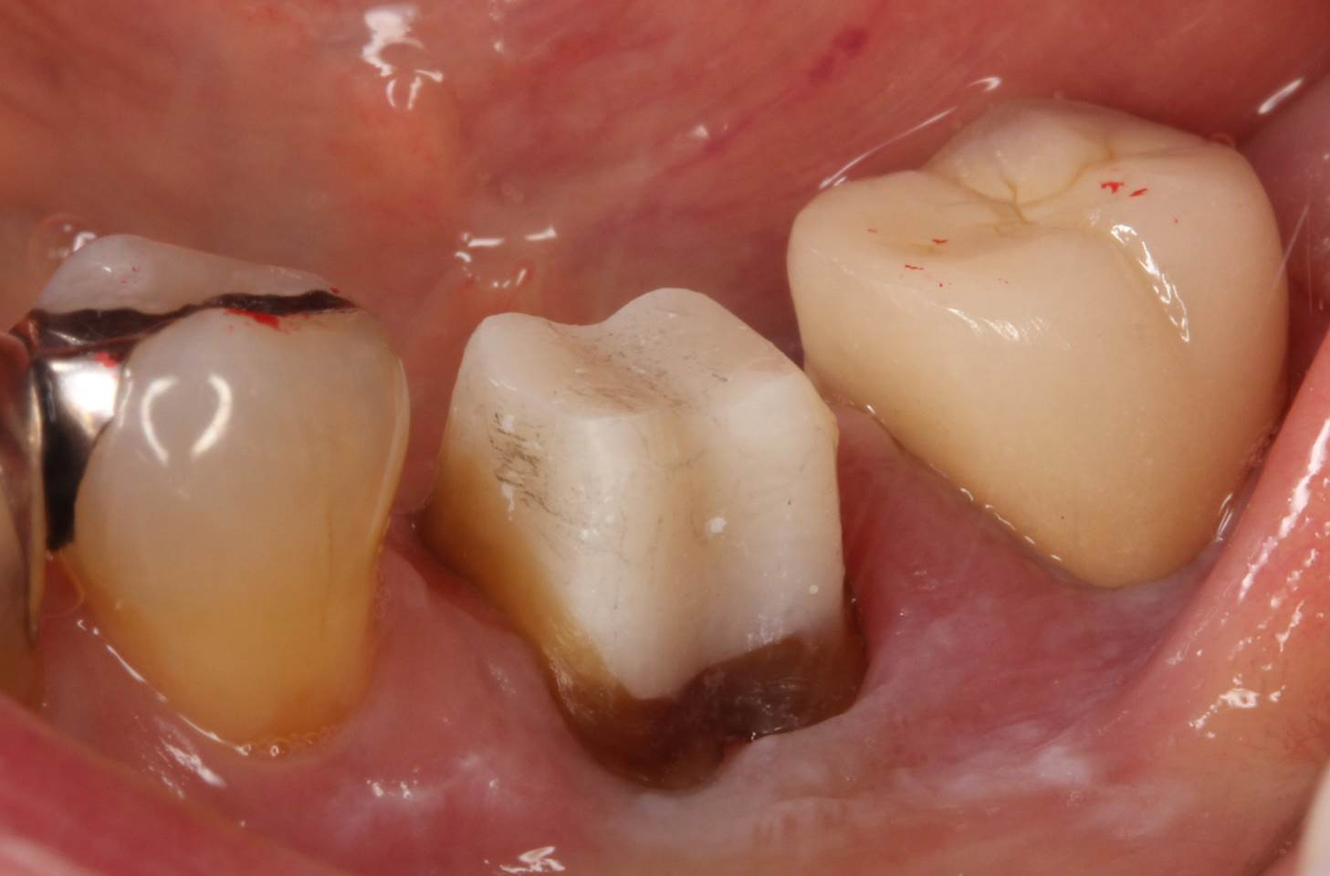 流山の歯科医院でファイバーコアを用いたメタルフリー治療を行っております。