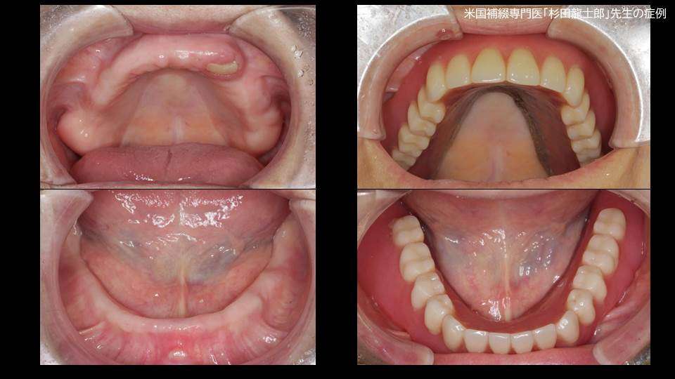 流山のグランツ歯科クリニックでは「上アゴを覆わない違和感が少ない総入れ歯」の治療が受けられます。
