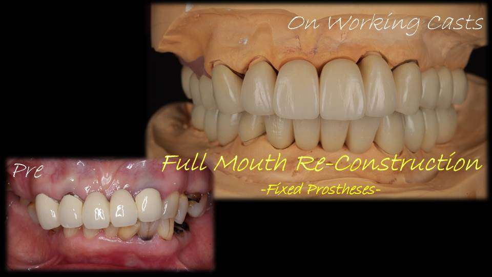 流山のグランツ歯科クリニックでは「歯医者が苦手」でもインプラントやセラミックスの治療が受けられます。