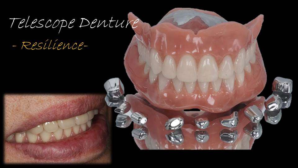 流山のグランツ歯科クリニックでは「よく咬めて違和感が少ない」テレスコープ義歯の治療が受けられます。