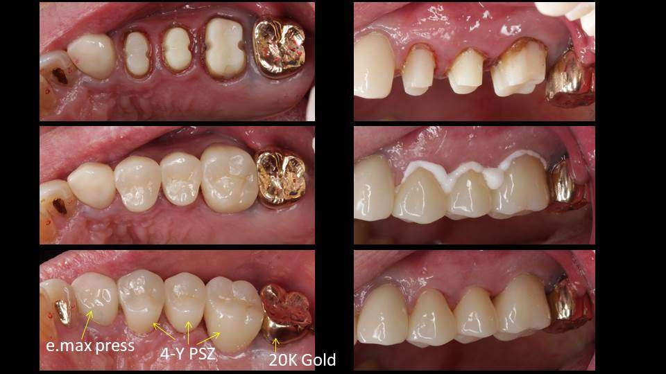 流山のグランツ歯科クリニックでは「色んな種類のセラミックス」で治療が受けられます。