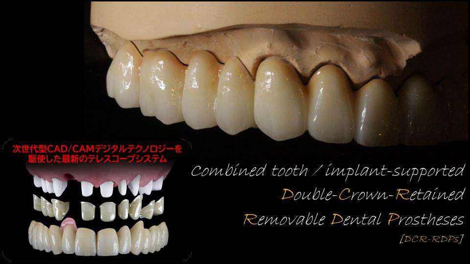 流山のグランツ歯科クリニックでは「よく咬めて違和感が少ない」インプラントで支える最新のテレスコープ義歯の治療が受けられます。