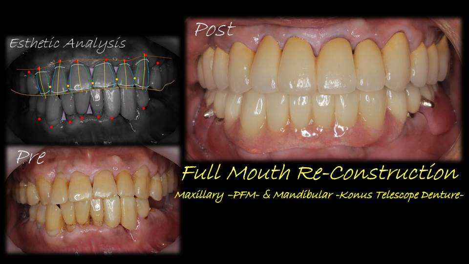 流山のグランツ歯科クリニックでは「よく咬めて違和感が少ない」テレスコープ義歯とセラミックスの治療が受けられます。