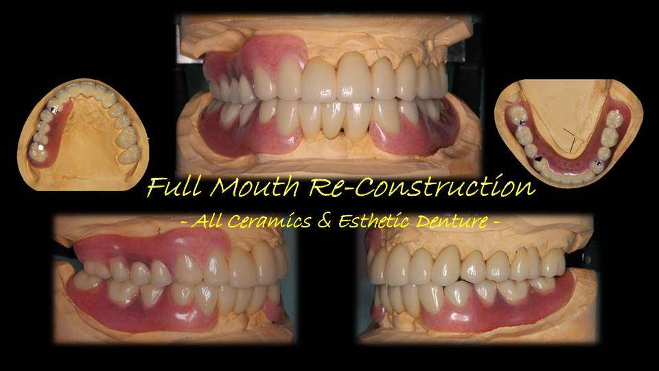 流山のグランツ歯科クリニックではセラミックスの専門治療と見た目が良い入れ歯の治療が受けられます。