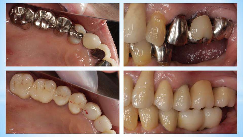 流山のグランツ歯科クリニックでは「銀歯ばっかりのお口の中」を白い歯で治療をします。