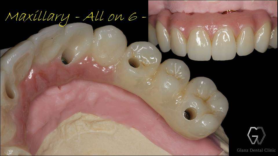 流山のグランツ歯科クリニックでは「米国補綴専門医」による「All on 4」「All on 6」のインプラント治療が受けられます。