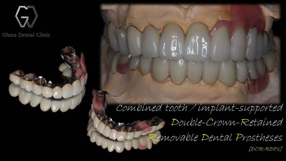 流山のグランツ歯科クリニックでは「グラグラ・ボロボロな歯」でもテレスコープシステムでの治療が受けられます。