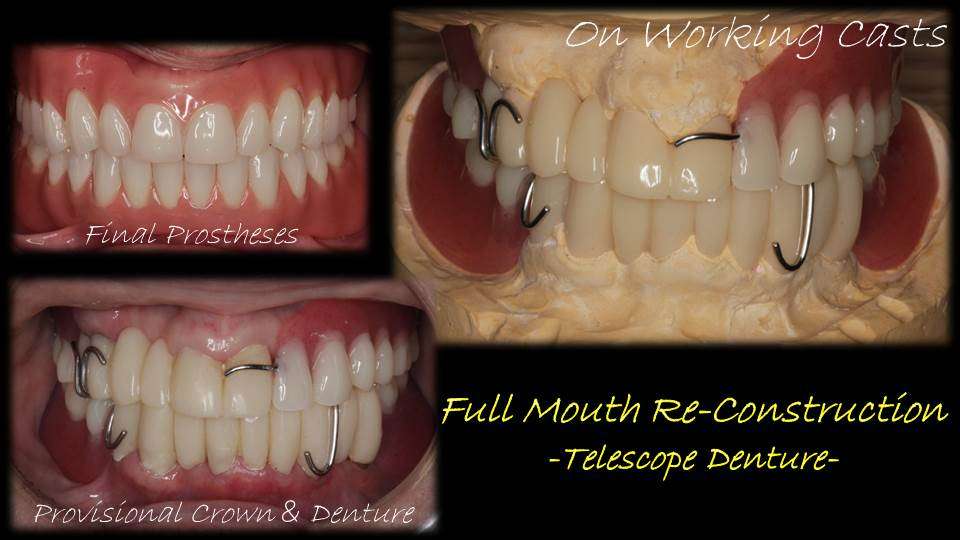 流山のグランツ歯科クリニックで「よく咬めて違和感が少ない」テレスコープ義歯の治療を受けませんか？