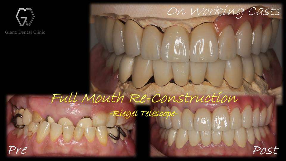 流山のグランツ歯科クリニックでは「違和感が少なく、よく咬めて、見た目が良い」テレスコープ義歯の治療が受けられます。