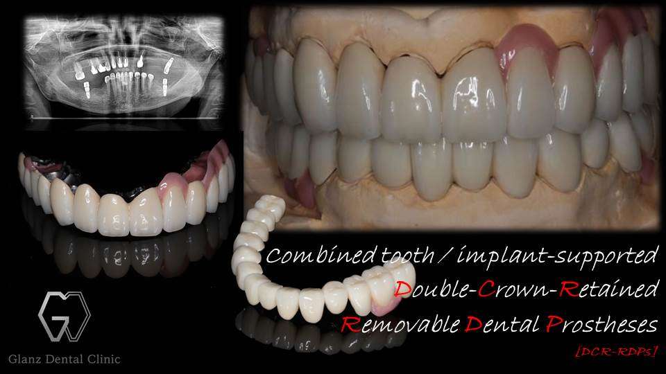 流山のグランツ歯科クリニックでは「グラグラな歯やボロボロな入れ歯」でもテレスコープシステムでの専門医治療が受けられます。