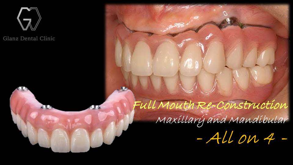 流山のグランツ歯科クリニックでは「All on ４(オールオン4)」「All on ６(オールオン6)」など、インプラントで支える「オールオン- X-」の専門治療が受けられます。