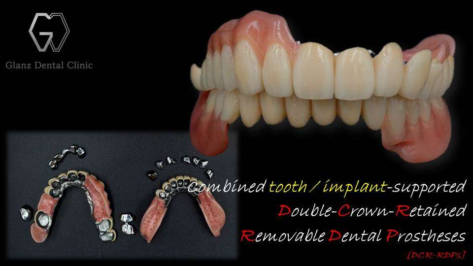 流山のグランツ歯科クリニックでは「よく咬めて、見た目が良くて、違和感が少ない」テレスコープ義歯の治療が受けられます。