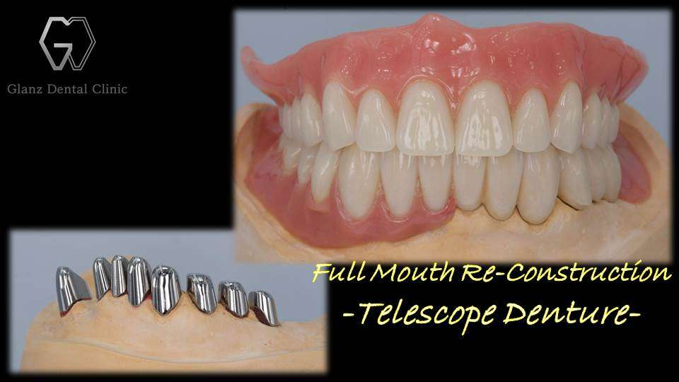 流山のグランツ歯科クリニックでは「入れ歯がボロボロ」な方でもテレスコープ義歯なら治療が受けられます。