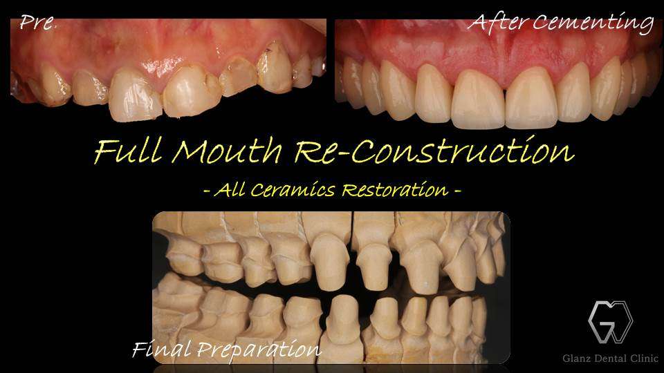 流山のグランツ歯科クリニックでは「酸蝕症や咬耗症」で歯が小さくなっていてもセラミックスの治療が受けられます。